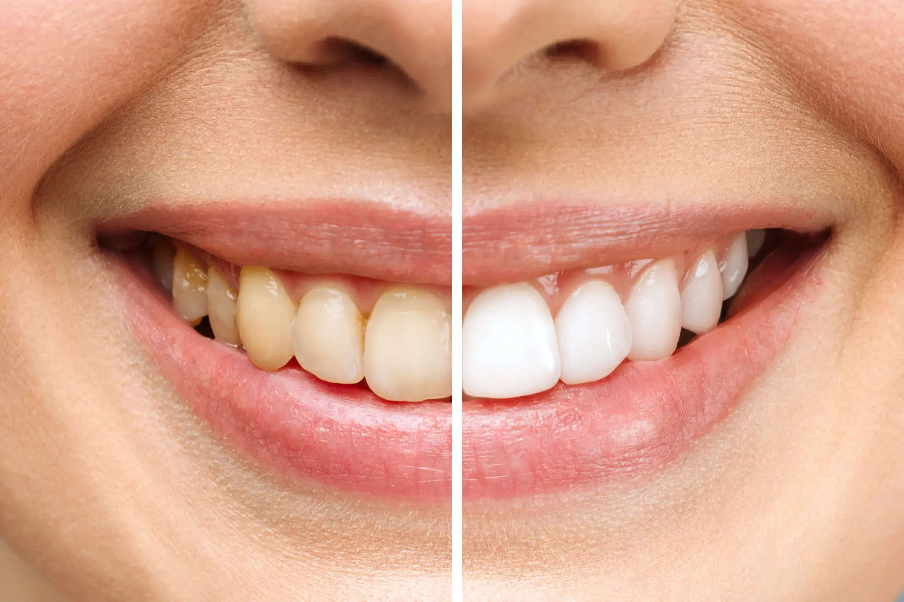 Professional teeth whitening